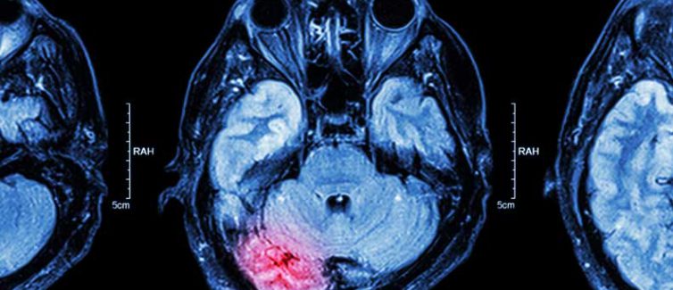 Sering Tersinggung, Mungkin Anda Berisiko Stroke