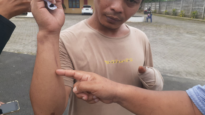 Pria di Medan Dianiaya hingga Empat Jari Tangannya Putus, Polisi Buru Pelaku