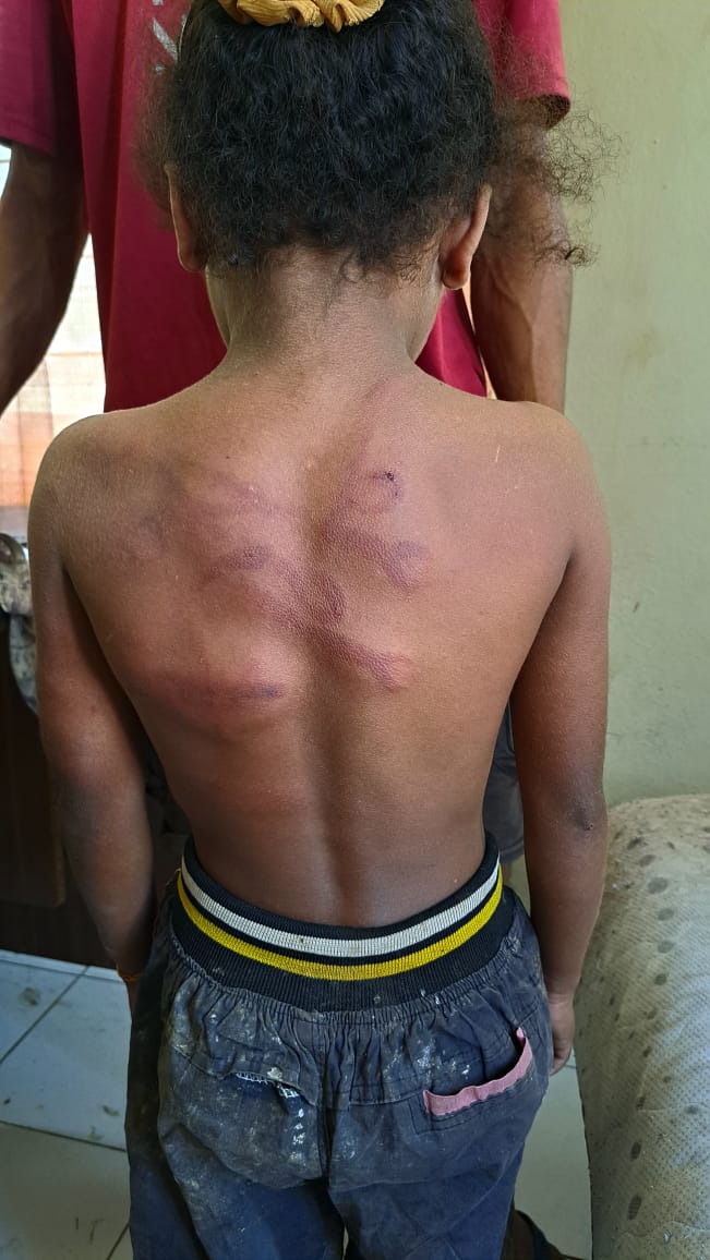 IRT di Sumba Timur-NTT Dipolisikan karena Aniaya Bocah 8 Tahun hingga Babak Belur