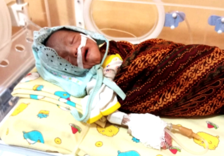 Miris! Bayi Berusia 2 Bulan di Sidimpuan Gizi Buruk Berat Hanya 1,7 Kg