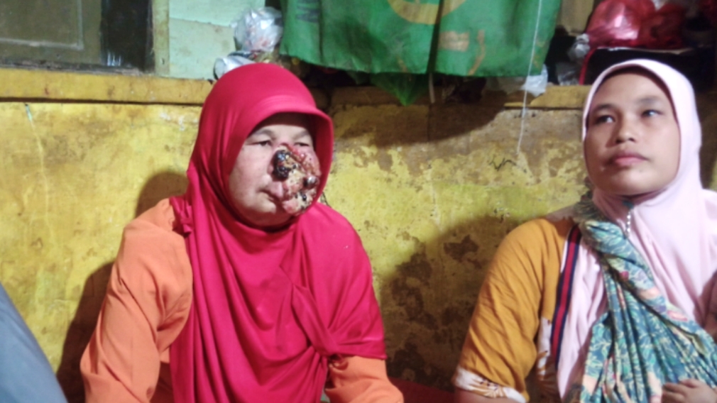 Wajah Wanita Paruh Baya di Tapsel Membusuk, Tidak Dirujuk Karena Biaya